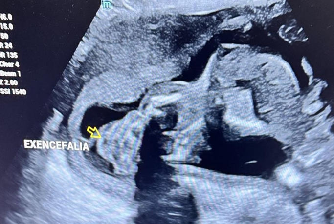 Figura 1. Exencefalia. Corte ecográfico fetal en el que se observa alteración de la bóveda craneana con exposición del tejido encefálico.